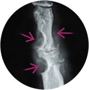 Gout Xray showing joint damage  