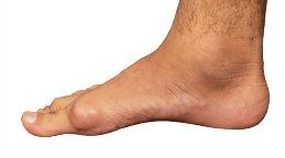 Tophus foot picture