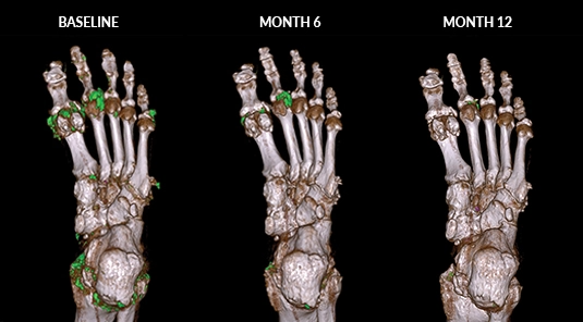 DECT scan of tophi in feet at Baseline, Month 6, and Month 12 of KRYSTEXXA treatment, with diminishing buildup from Baseline to Month 12