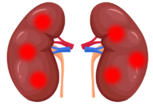 chronic-kidney